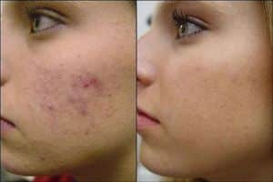 acne rimedi naturali