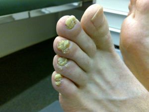 psoriasi unghie piedi