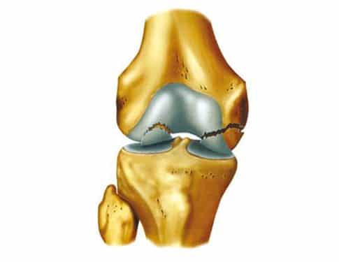 dolore ginocchio cartilagine