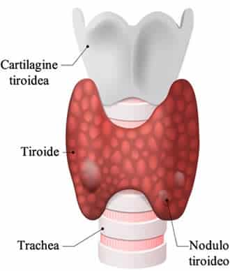 tiroide cellulite