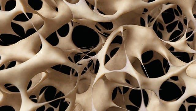 bufale osteoporosi più pericolose