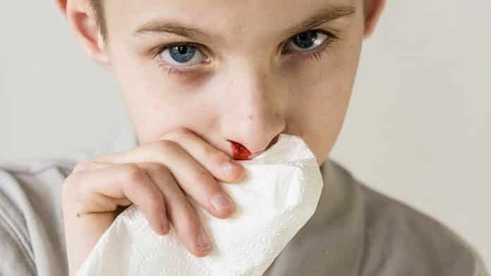 sangue dal naso cause più comuni