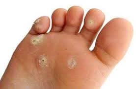 callo ai piedi occhio di pernice