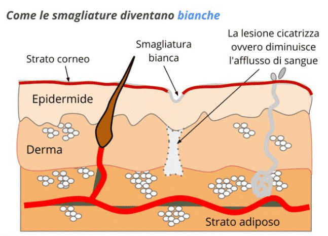 smagliature bianche