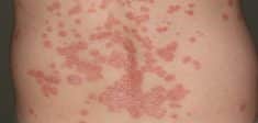 psoriasi guttata cura