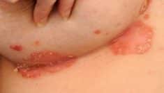 psoriasi inversa