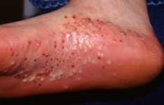 psoriasi pustolosa
