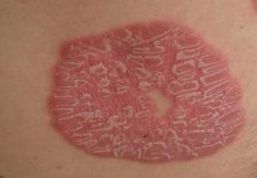 psoriasi volgare